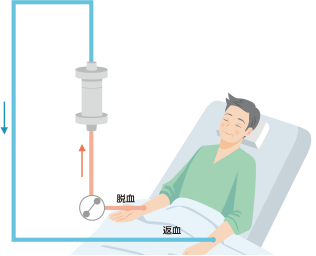 血球成分除去療法ってなに？