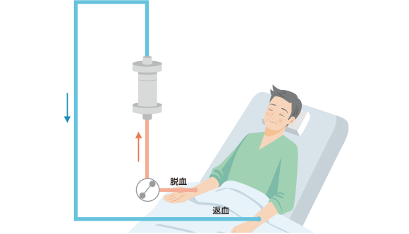 血球成分除去療法ってなに？