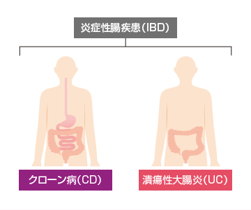 炎症性腸疾患 潰瘍性大腸炎 クローン病
