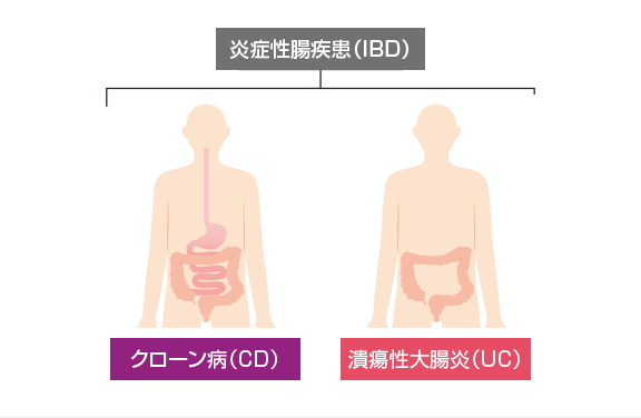 炎症性腸疾患 潰瘍性大腸炎 クローン病