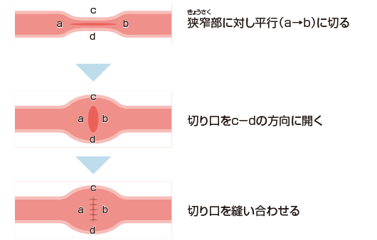 狭窄に対する手術（例）